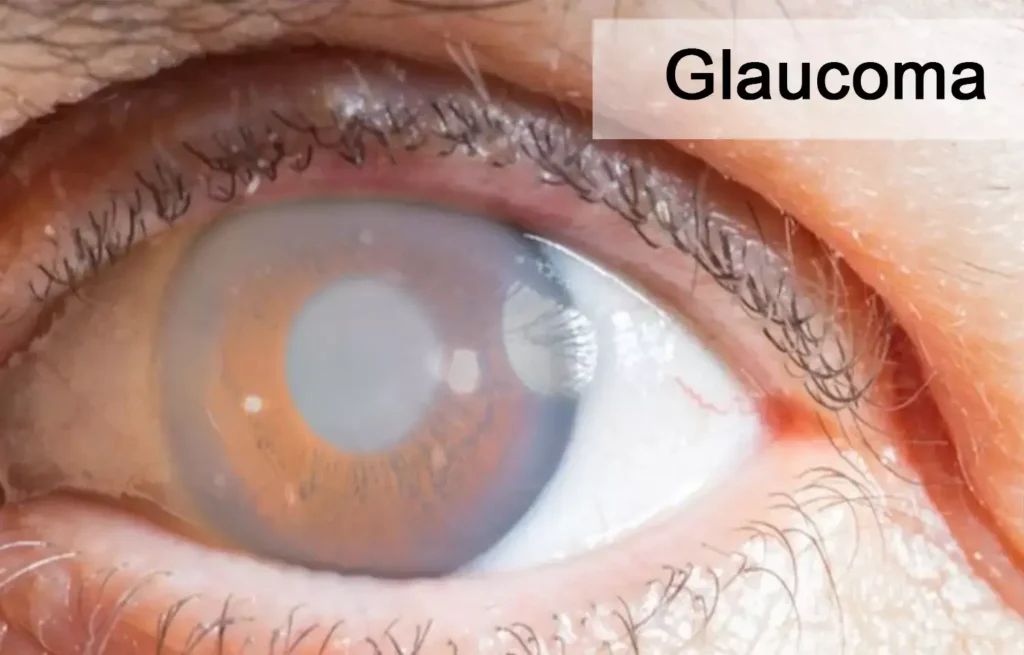 Glaucoma_Specialist_In_Kalyan