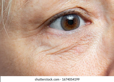 Eye Socket Molding 