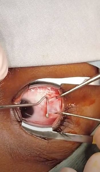 60d160172ecaa22ee8caa3ee_strabismus-surgery