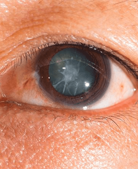 Cataract_Removal_Surgery_In_Kalyan