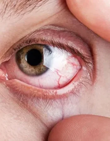 Unveiling-Dry-Eye-Syndrome-blog