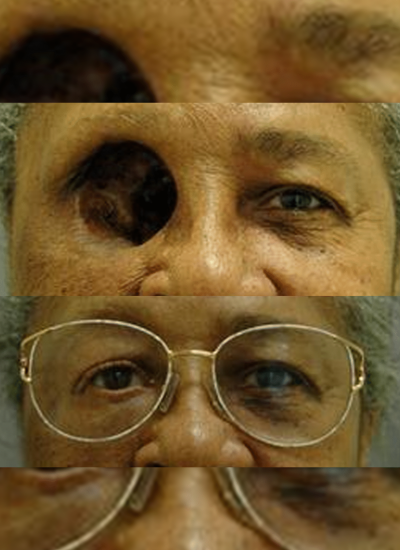 artificial-eye-prosthetic - Section img
