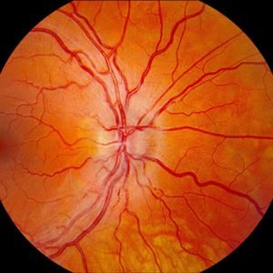 fig1a-com-2011-10 A 29-year-old male presented with a two-week history of acute visual loss in both eyes. VA 20/200 OU