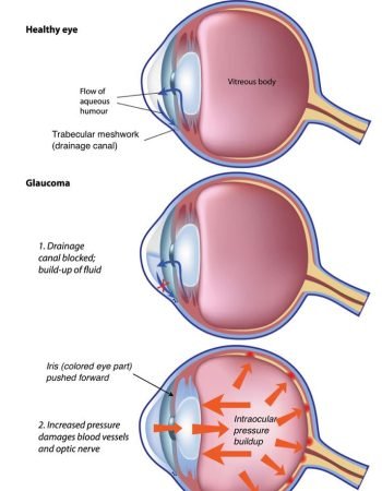 glaucoma-development-713x1024